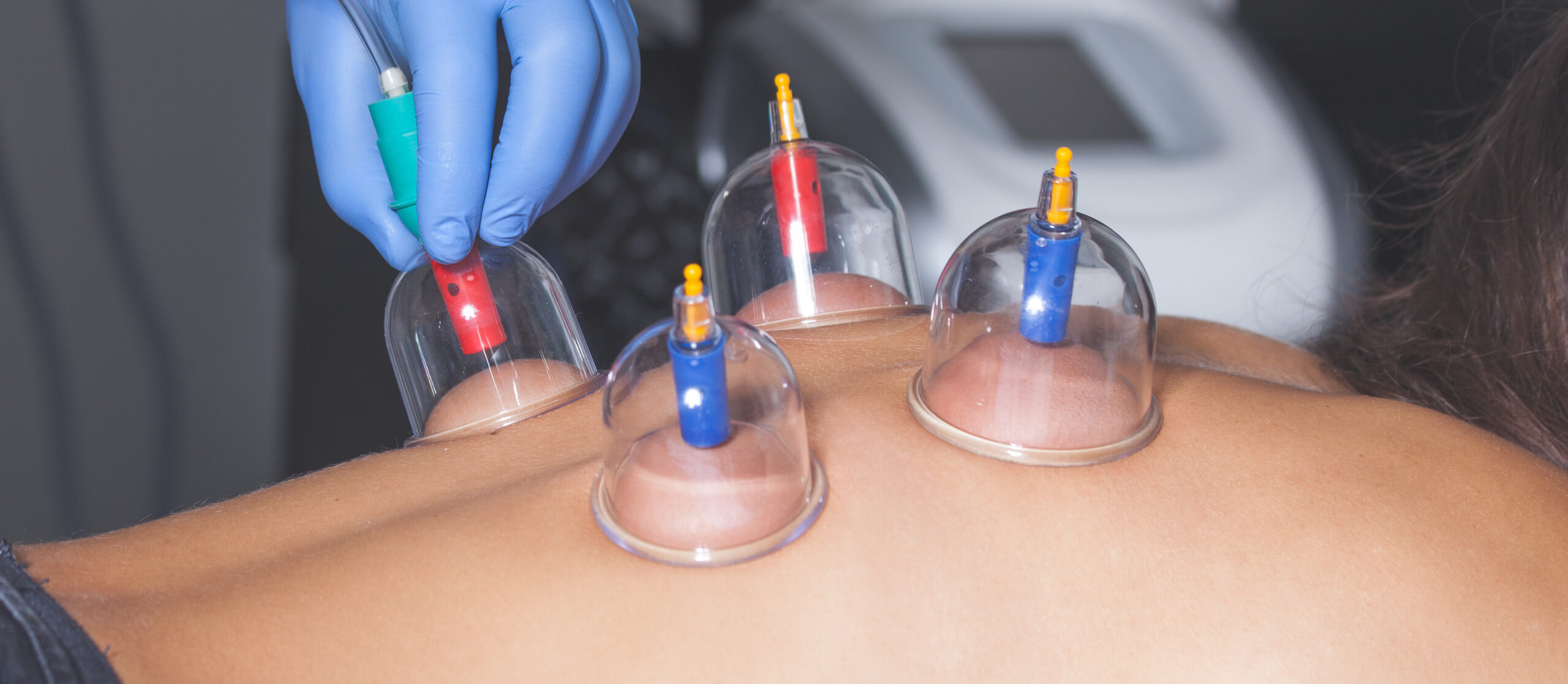 Cupping therapy Franklin, Nolensville, Brentwood and Nashville, TN